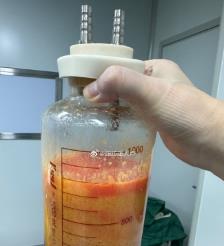 余江水动力吸脂手术要做多久？